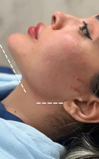 تزریق ژل ، بوتاکس ، مزو