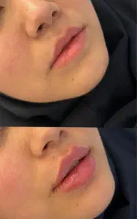 فیلر لب
