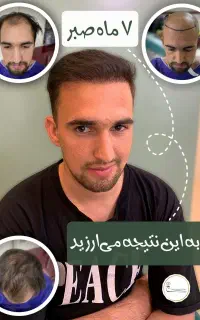کاشت مو و ابروی تخصصی با امکان پرداخت اقساطی