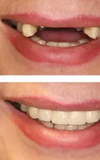 تخفیف ایمپلنت کره ای  تضمینی با روکش زیرکونیا