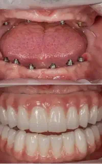 دندانپزشکی،اوردنچر دو فک ۱۸۵ تومن در تبریز