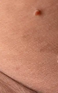 درمان قطعی زیگیل و تبخال تناسلی