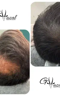 میکرواسکالپ کف سر . میکروابرو . بن مژه