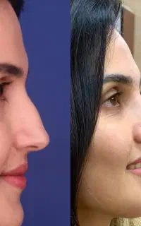 جراحی بینی با روش و تکنیک جدید،تخفیف ویژه