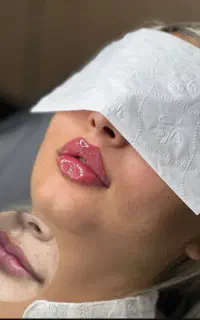 ژل لب/بوتاکس/ نخ گذاری/فیلر بادی