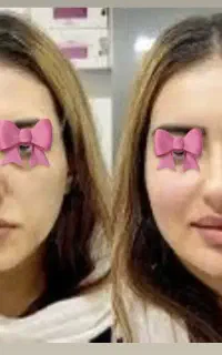 بوتاکس/فیلر صورت/کلینیک فرسیما/بوتاکس/نخ