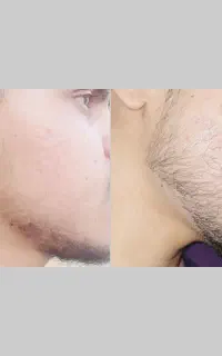 ریشاتو پر کن