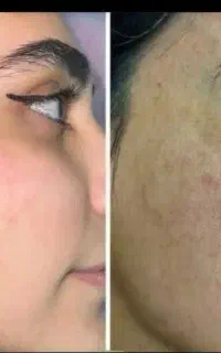 کرم درمانی هزار برگ