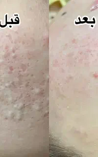 فیشیال تخصصی پوست VIP