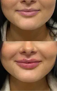 تزریق ژل و بوتاکس نیم فیس و فول فیس
