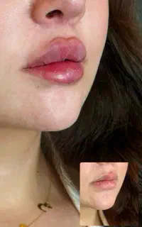 تخفیفات تزریق ژل و بوتاکس کلینیک زیبایی