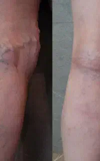درمان دائمی وبدون بازگشت واریس به صورت کاملا گیاهی