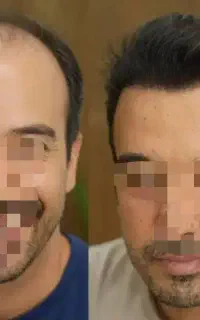 کاشت مو ابروبلفاراقساطی باگارانتی مادام العمر