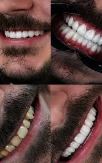 خدمات وآموزش کامپوزیت کاشت موو ابرو ومعرفی به کار
