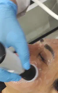 فشیال پلاژن هیدرودرمی میکرودرم جوانسازی مزو