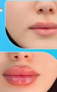 تزریق ژل وبوتاکس ،مزوتراپی،برداشتن خال وکک ومک