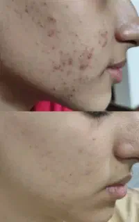 ۳۰ درصد تخفیف پاکسازی پوست ومشاوره رایگان پوست ومو