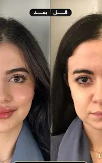 جشنواره تزریق ژل و بوتاکسوکانتورصورت وآموزش