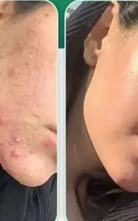 مشکل پوستت روبگو،راهکار مناسبش بامن(مشاوره رایگان)
