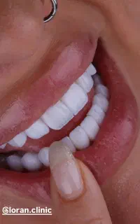 خدمات دندان پزشکی  کامپوزیت فقط واحدی ۴/۵ عصب کشی