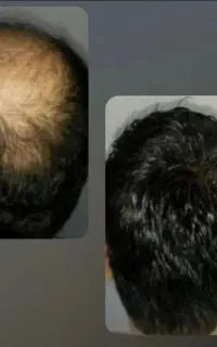 برای کم پشتی موهات مجبور نیستی کلاه بزاری