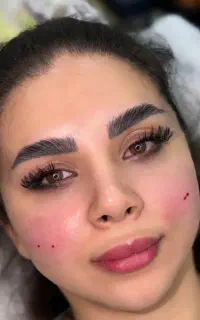فیلر ،بوتاکس،مزو ،مزوژل،لیفت بانخ
