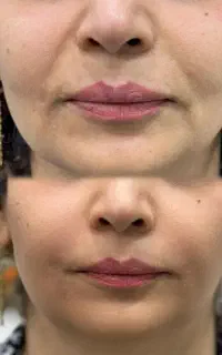 ژل و بوتاکس
