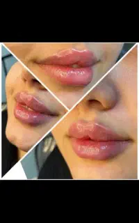 تزریق ژل ،بوتاکس، مزوژل جوانساز،توسط پزشک