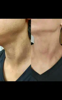 بمب روشنی پوست