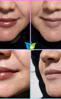 تزریق ژل بوتاکس جوانسازی پی آر پی کربوکسی و لاغری