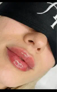 تخفیف ۳۵ درصدی تزریق بوتاکس و فیلر کلینیک زیبایی