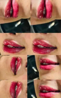 تزریق ژل و بوتاکس بهترین متریال  و سابقه کاری