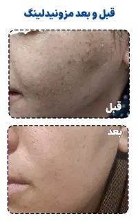 بوتاکس فقط 800