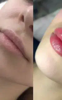 خدمات زیبایی با تزریق ژل و فیلر