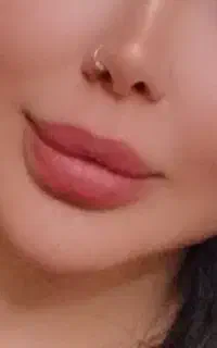 تزریق فیلر و بوتاکس در فردیس