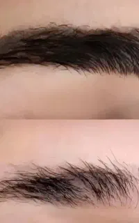 رفع تیرگی بالیزر کیوسوئیچ صورت بیکینی و ریموتاتو