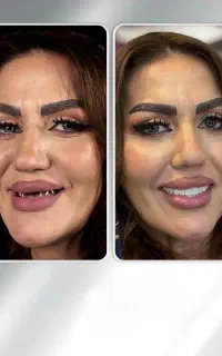 پر کردن جای خالی لبخندتان