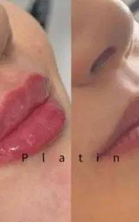 تزریق فیلرلب/مادلینگ صورت/فیلربادی/لیفت نخ جوانساز