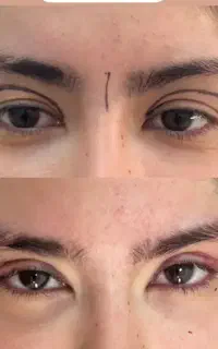 بلفاروپلاستی لیزری فقط ۱۴.۹۰۰