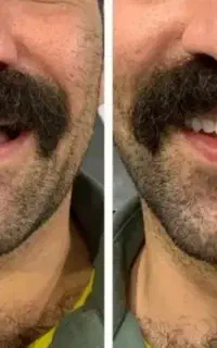 دندانسازی دندان مصنوعی