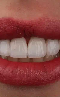ایمپلنت فوری با اقساط بلند مدت/دندانپزشکی/ اوردنچر