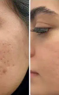 پی ار پی ، مزوتراپی ، مزوژل ،