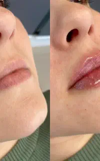 تزریق فیلر بوتاکس زیبایی نچرال