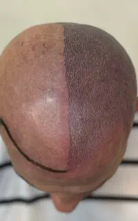 میکرواسکالپ سر ( پوشش کچلی )
