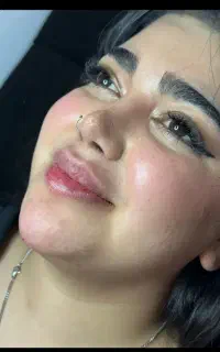 تزریق ژل(فیلر) هم نقد هم اقساط