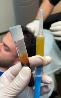 جشنواره prpو prfصورت و مو با کیت اصلی