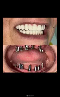 دندان مصنوعی بر پایه ایمپلنت(زهره)