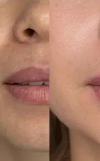 تزریق ژل فیلر بوتاکس مزوتراپی پی آرپی مو ابرو صورت