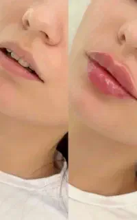 بوتاکس ۴۹۹ هزار تومان (مصپورت)