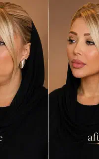 آف RGA لاغری شکم فیلربادی غبغب باسن ژل سینه ابرو